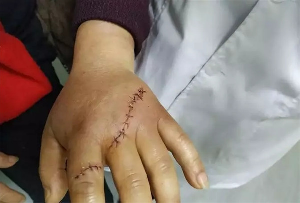 "从当时在医院拍摄的照片可以看到,唐学良的左手整个手背和食指下段